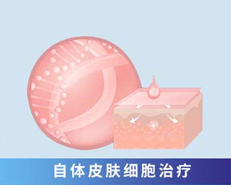 自體皮膚細(xì)胞治療